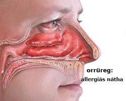 allergiás nátha
