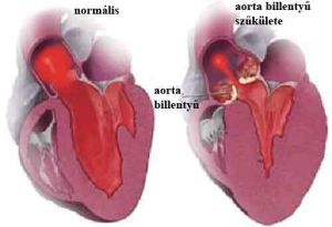 aortaszűkület