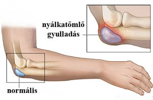 nyálkatömlő gyulladás