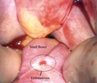Endometriózis