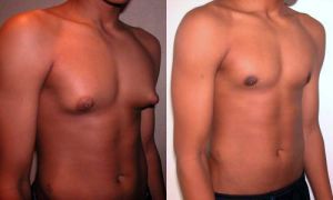 gynaecomastia növekvő férfimell 