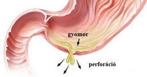 gyomor perforáció