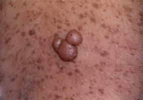 neurofibromatózis