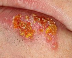 herpes-labialis ajakherpesz