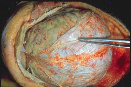 meningitis