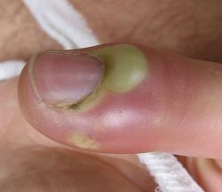 panaritium