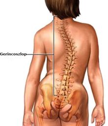 Scoliosis