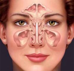 sinusitis