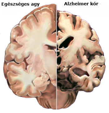 Alzheimer kóros agy