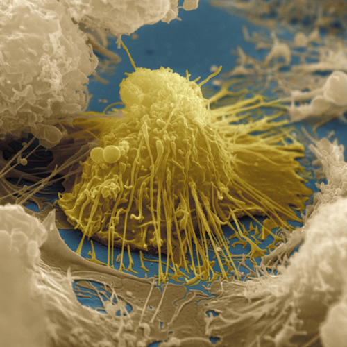 agammaglobulinaemia