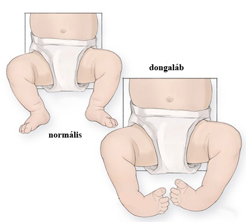dongaláb betegség