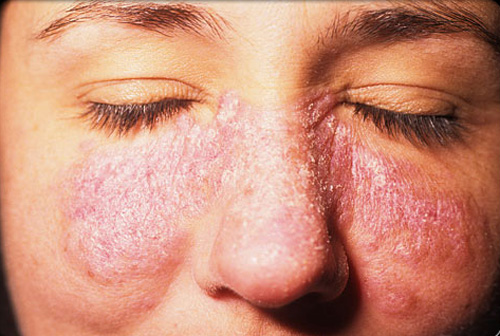 lupus betegség