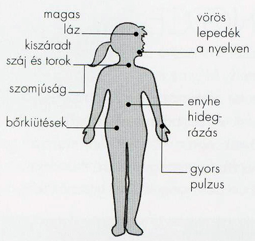 szél-meleg szindróma