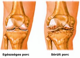 arthrosis