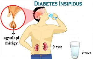 diabetes insipidus 