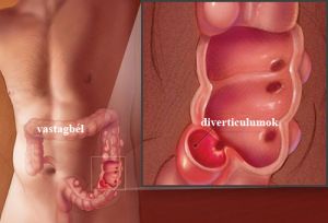 diverticulum gyulladás