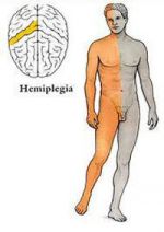 Hemiplegia - féloldali bénulás