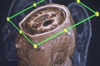 Krónikus vegetatív állapot
