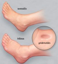 lábödéma