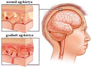 meningitis agyhártyagyulladás