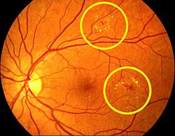 retina betegség