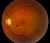 retinasérülés