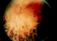 retinitis pigmentosa