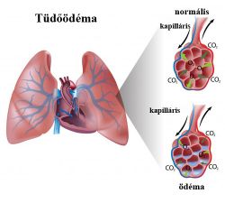 tüdőödéma