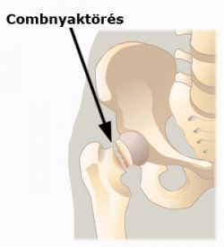 combnyaktörés