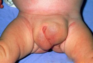 Lágyéksérv inguinalis-hernia