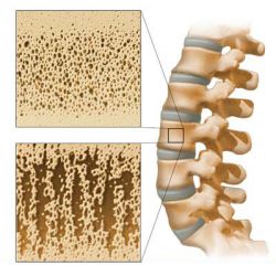 osteoporosis